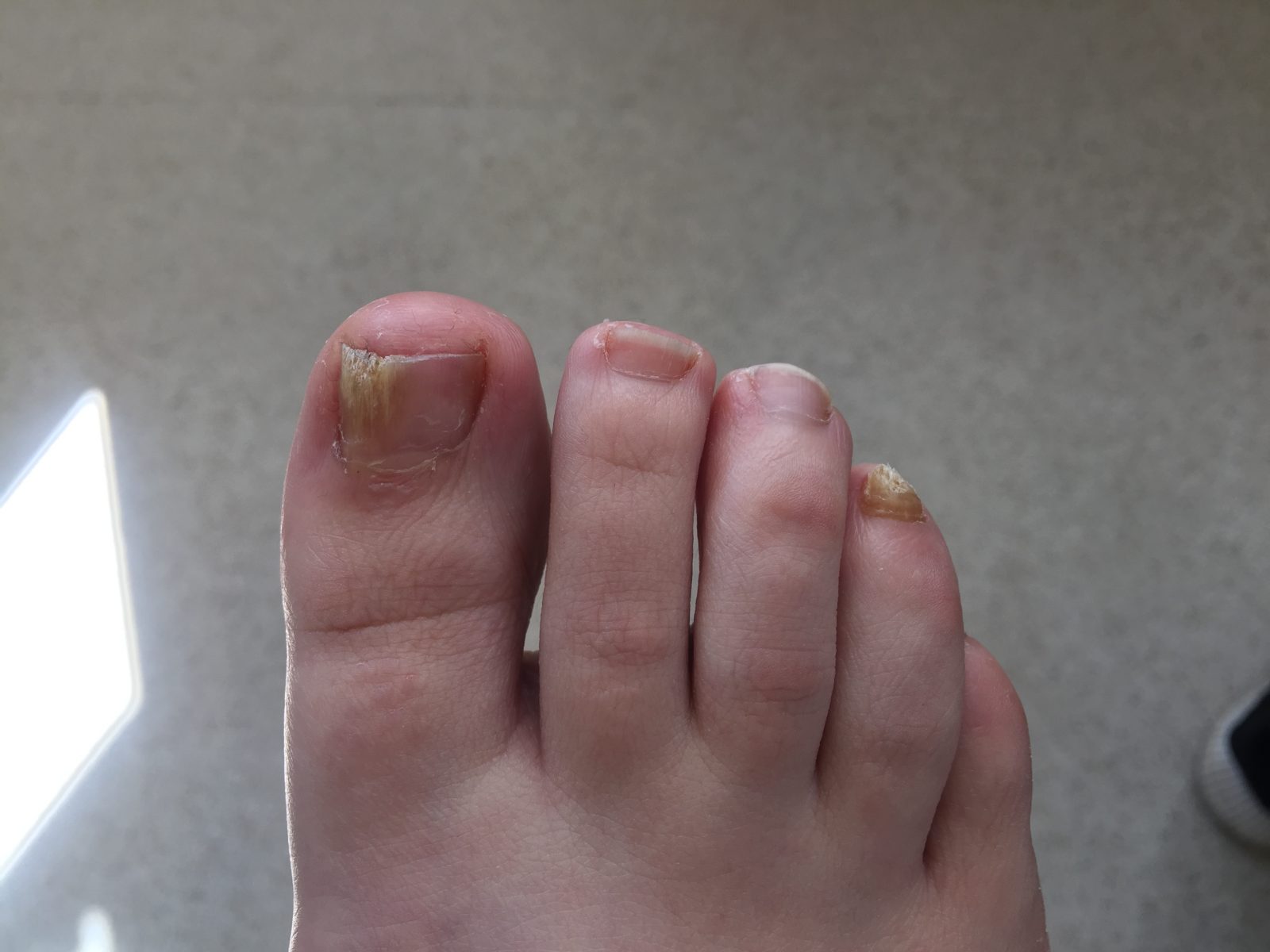 Effective Nail Reconstruction Professional Podiatry Chiropody