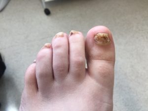 Effective Nail Reconstruction