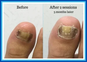 Lacuna Method for Fungal Nails