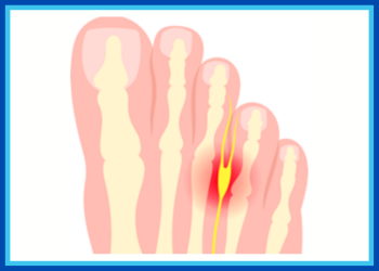 Understanding Morton’s Neuroma: A Guide to Relief