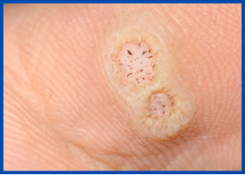 Minor Surgical Services at Medipod Clinics