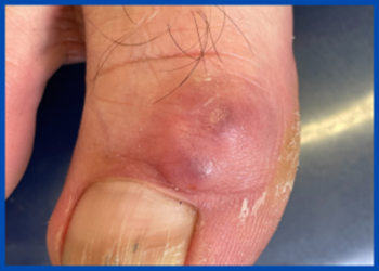 Minor Surgical Services at Medipod Clinics