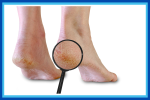 Why Heels Crack in Winter (and How to Stop It)