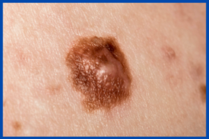 The Spot You Shouldn’t Ignore: Why Skin Lesion Checks Matter